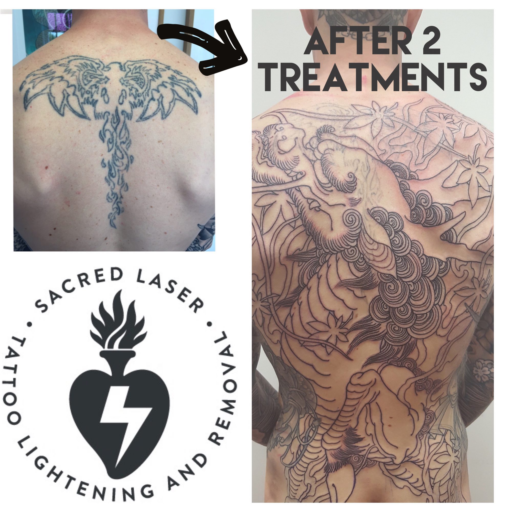 Tattoo Removal for CoverUps Before  After Results