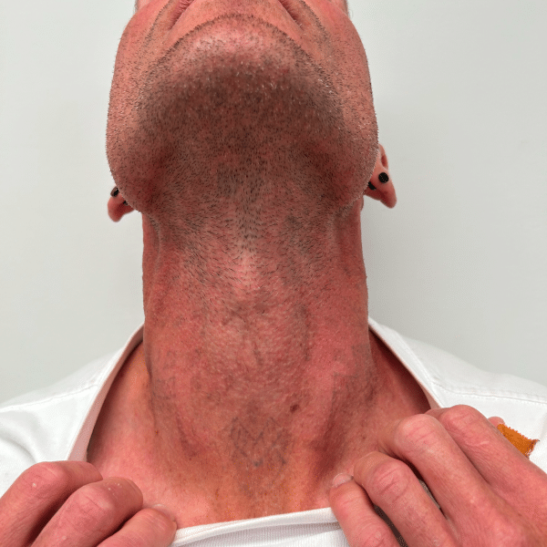 Man's neck showing light tattoo, hands pulling shirt open for Sacred Laser