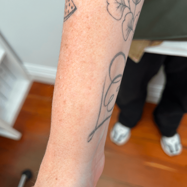 Arm showing two tattoos, one of a pizza slice and another of a flower, after laser tattoo removal