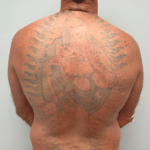 Cover up your old Tattoo by clearing the way with Tattoo Removal/Lightening .