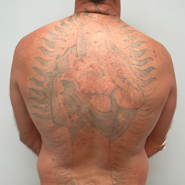 Man's back with faded tattoo before removal or lightening treatment