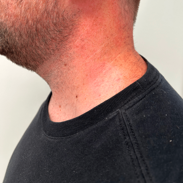 Close-up of a man's neck showing tattoo removal