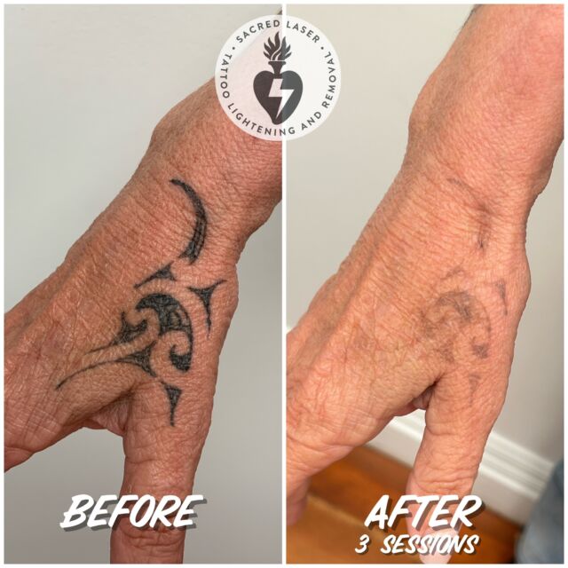 Before and After Gallery - Tattoo Removals Auckland