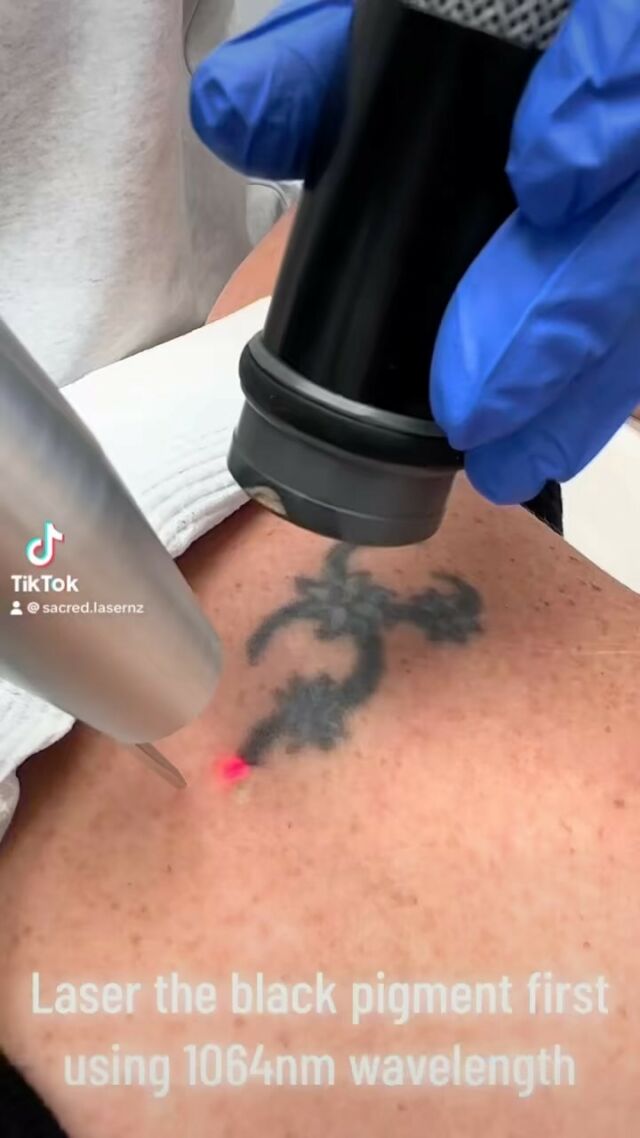 Tattoo Removal - Avana Cosmetic & Laser Clinic